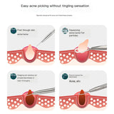 Pimple Extraction Tool Set for Beauty Salons